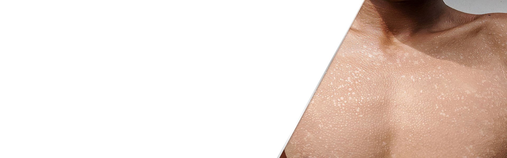background-tinea-versicolor